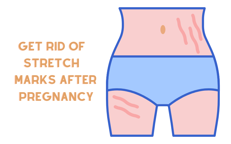 How To Get Rid Of Stretch Marks After Pregnancy — Fair Play Canada