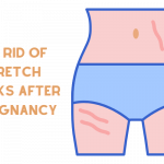 Get Rid of Stretch Marks After Pregnancy
